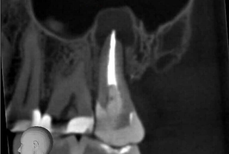 CBCT image of failed root canal treated tooth