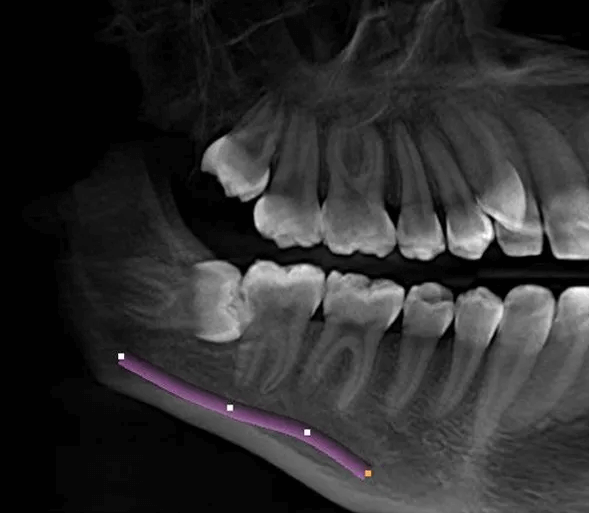 CBCT scan wisdom teeth