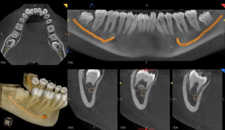CBCT scan wisdom teeth