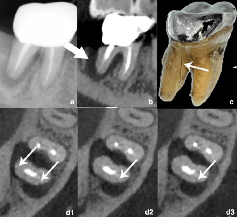Cracked tooth CBCT scan