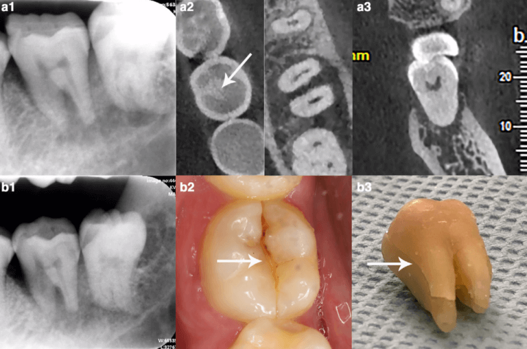 Cracked tooth CBCT scan