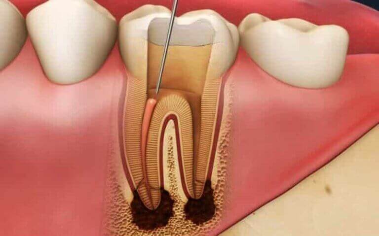 Failed root canal treated tooth