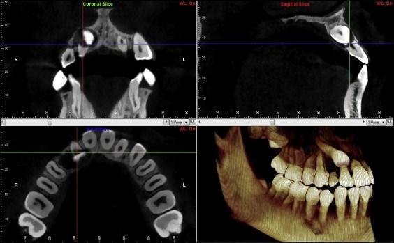 Impacted wisdom tooth CBCT