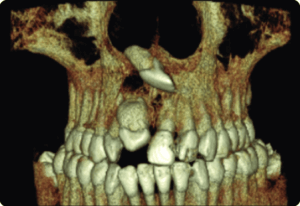 Supernumerary teeth CBCT scan