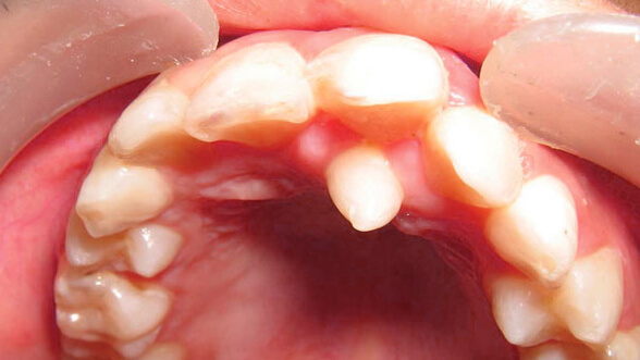 Supernumerary mesiodens tooth