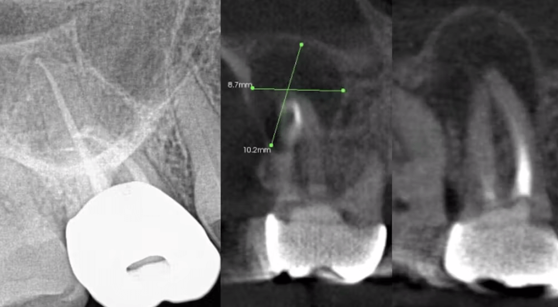 CBCT Scans For Tooth Abscess - Oral Radiology Toronto