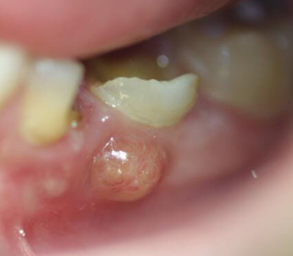 Tooth abscess parulis
