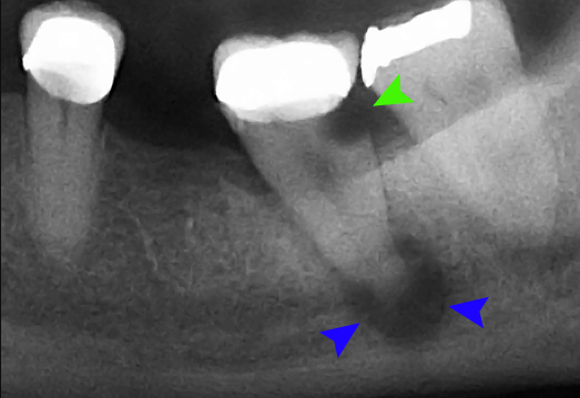 Tooth abscess periapical x-ray