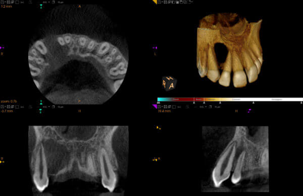 CBCT dental cyst