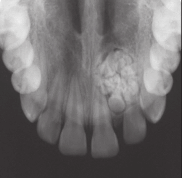 CBCT dental tumor