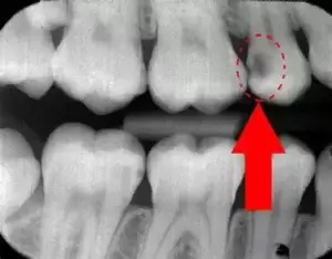 Dental caries x-ray