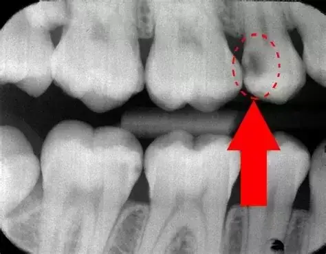 Dental caries x-ray