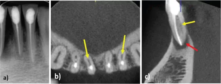 Failed root canal treatment CBCT