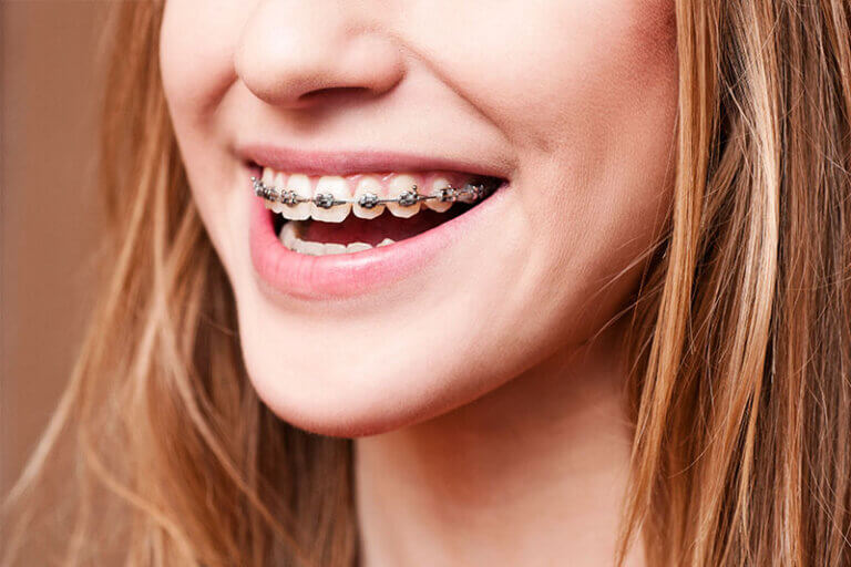 Girl smiling with orthodontic braces on maxillary teeth