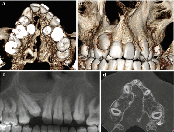 Orthodontic braces CBCT scan