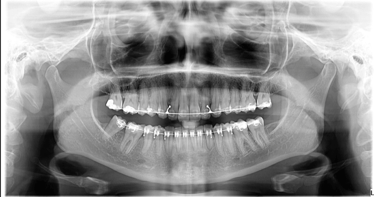 Orthodontic braces panoramic x-ray
