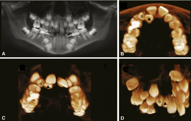Supernumerary teeth CBCT
